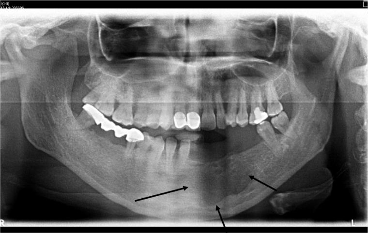 Case 1 – IAOP